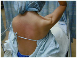 Lateral scapula winging of CNXI palsy