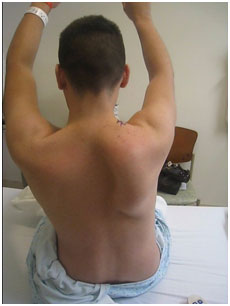 Scapula winging associated with long thoracic nerve palsy